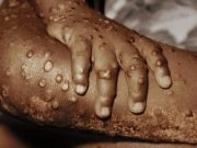 Detectan nuevos casos de viruela del mono
