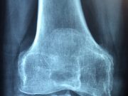 En México 10 millones de personas viven con osteoporosis