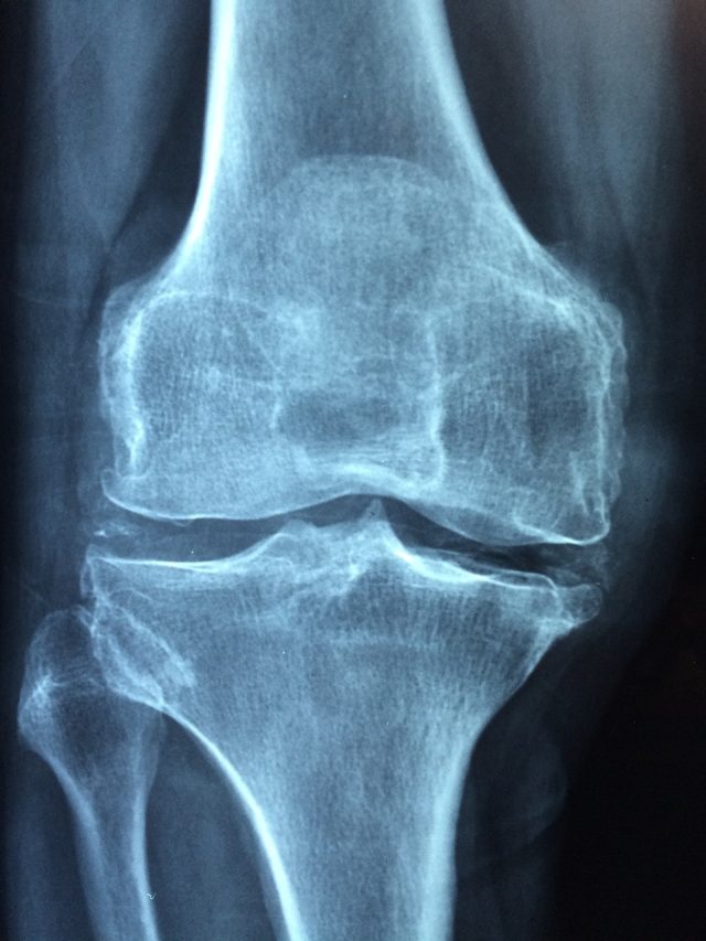 En México 10 millones de personas viven con osteoporosis