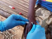 OMS activa plan para frenar la propagación de la viruela símica Vacunación contra la viruela sísmica